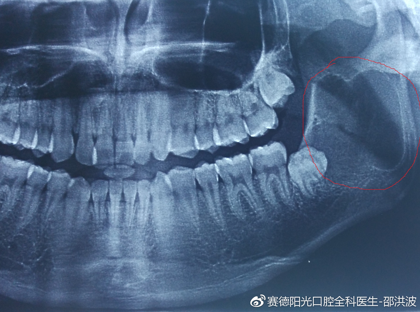 供卵做三代代生试管移植后如何服用达芙乐？正确的服用方法才能保住孩子的性命!