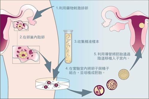 女方可以单独做试管婴儿吗